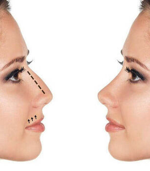 Реабилитация после ринопластики Реабилитация после ринопластики - Назар Грицевич во Львове