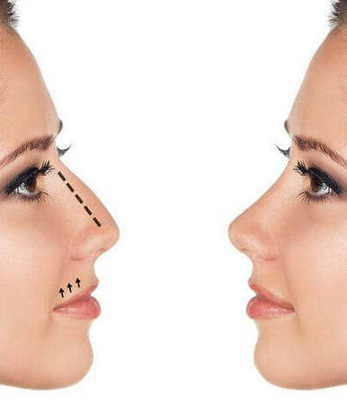 Реабилитация после ринопластики