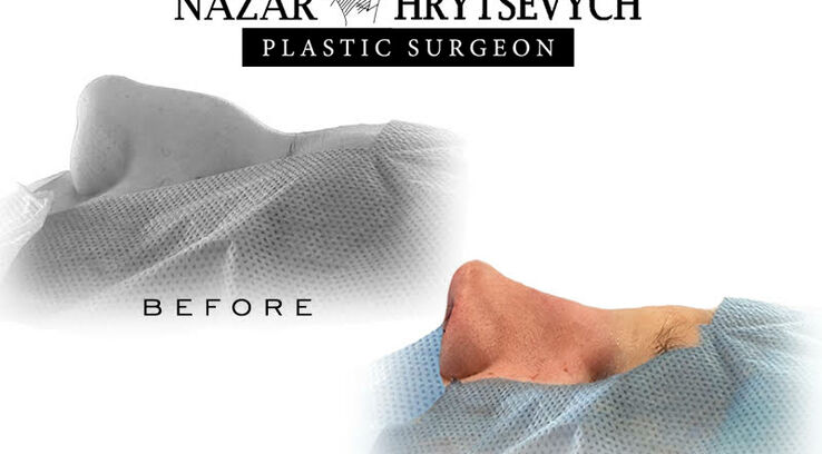 До і після контурної пластика носа
