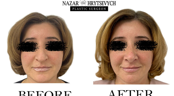 Приклад ринопластики