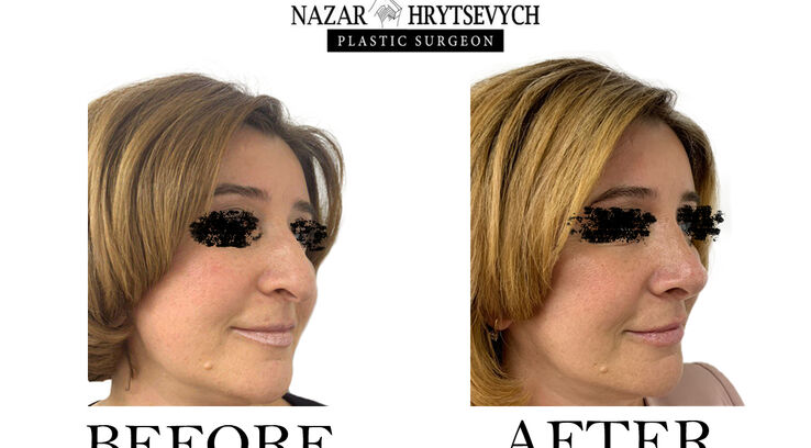 Приклад контурної пластика носа