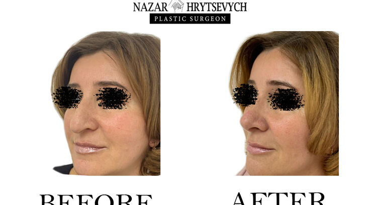 Контурна пластика носа до і після