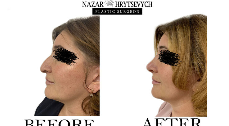 До і після ринопластики