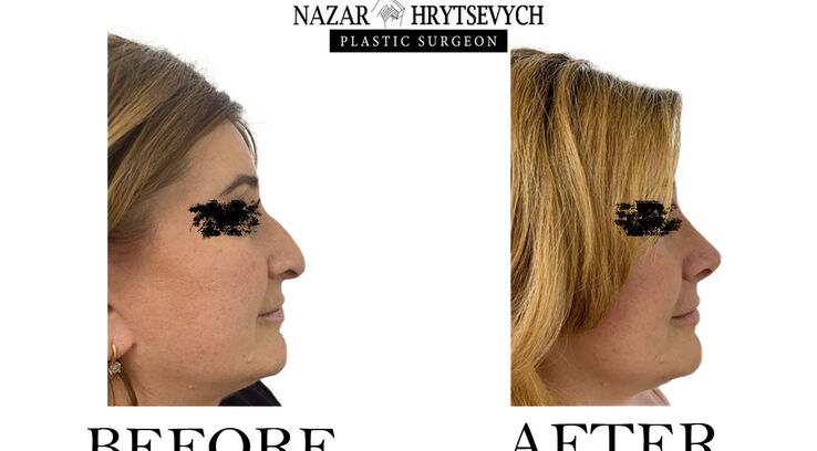 Контурна пластика носа приклад