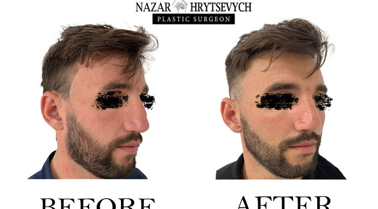 Приклад пластичної операції на ніс