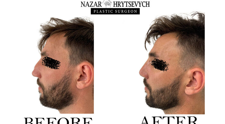 Пластична операція на ніс до і після