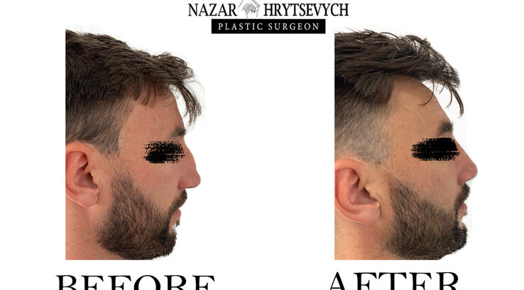 До і після пластики носа