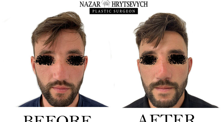 Пластична операція на ніс до і після