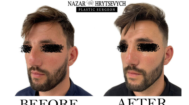 Приклад пластичної операції на ніс