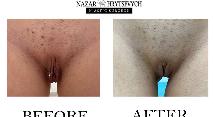 Лабіопластика до і після