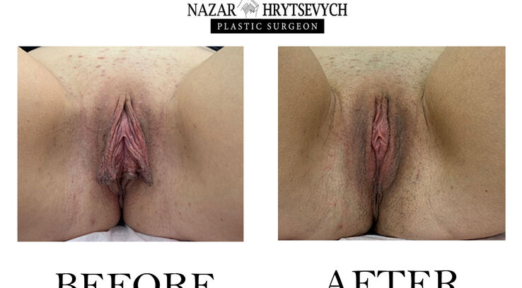 Інтимна контурна пластика до і після