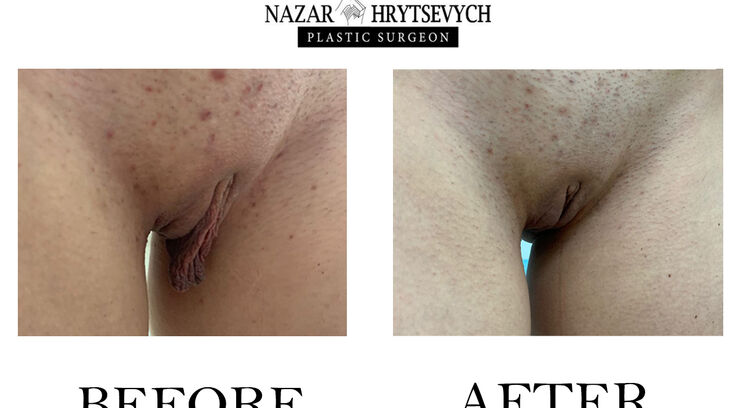 Інтимна пластика до і після