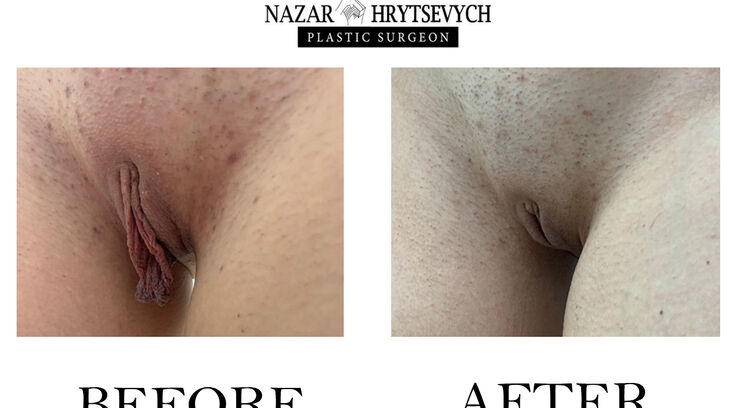 Лабіопластика приклад