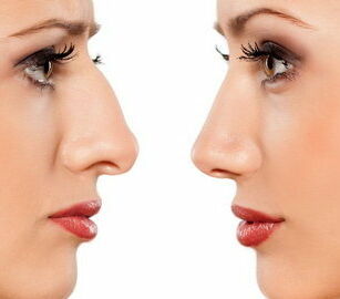 Пластика носа: отпор комплексам и здоровое дыхание Пластика носа: отпор комплексам и здоровое дыхание - Назар Грицевич во Львове