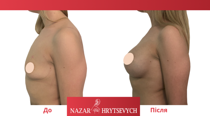 Збільшення грудей до і після