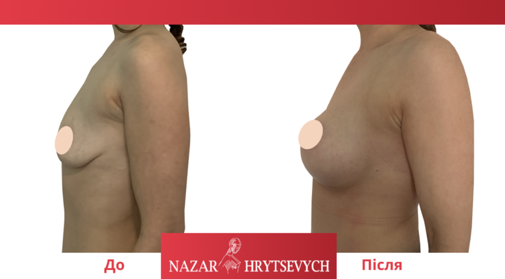 До і після операція по збільшенню грудей