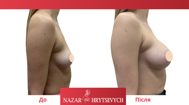 Збільшення грудей імплантами до і після