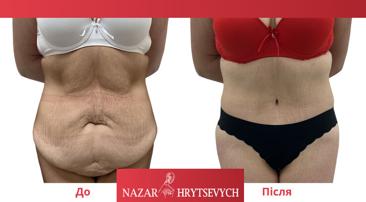 До и после абдоминопластики