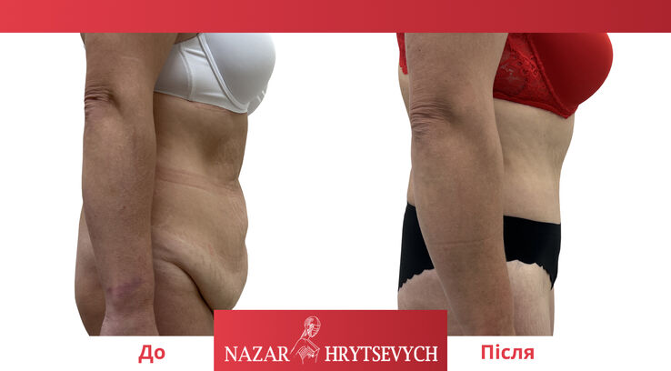 Абдоминопластика до и после