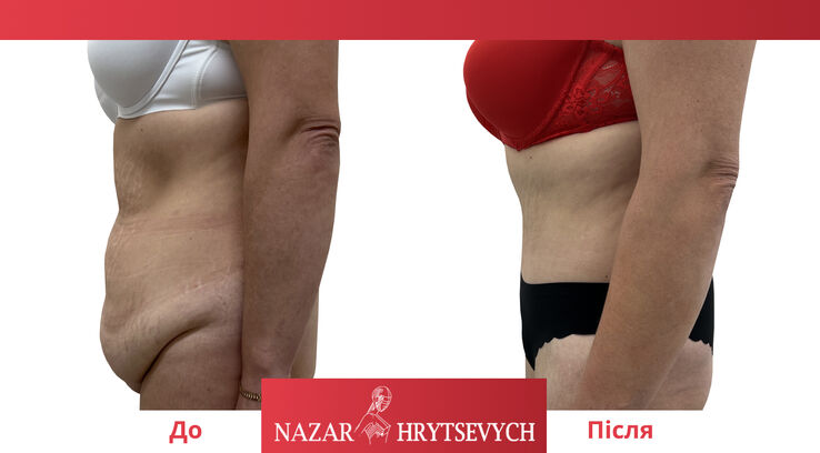 Фото абдоминопластики