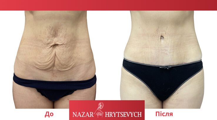 Пример абдоминопластики живота