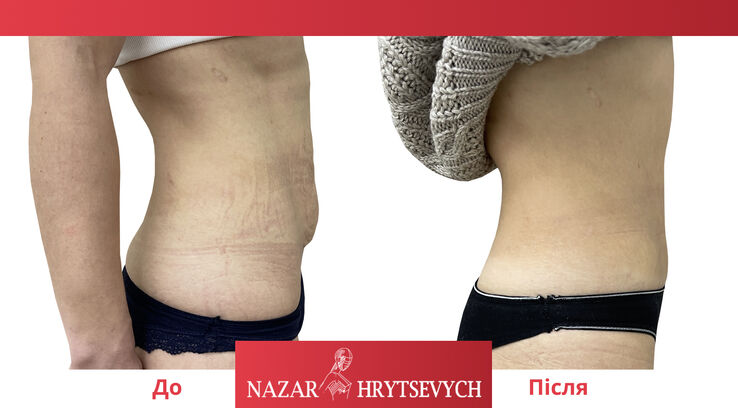 Пластика живота до и после