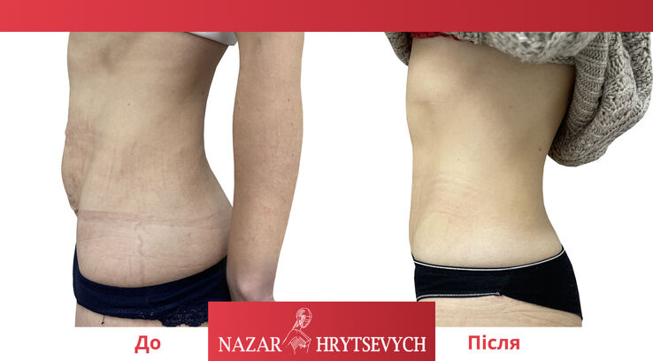 До и после пластики живота