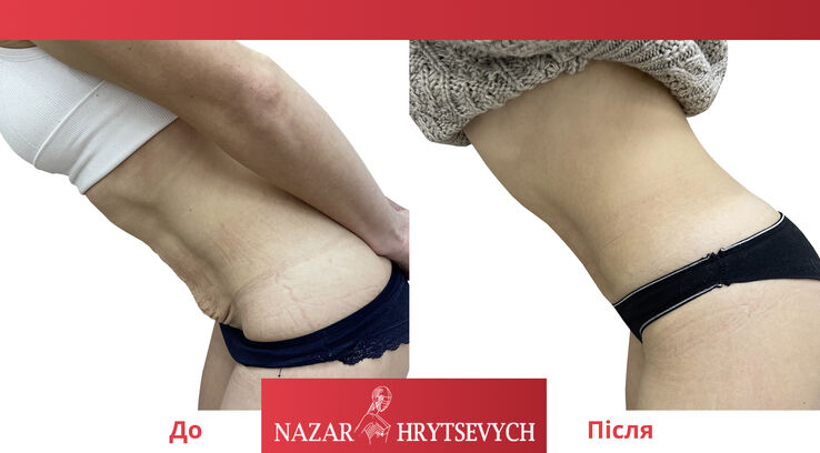 Пример пластики живота