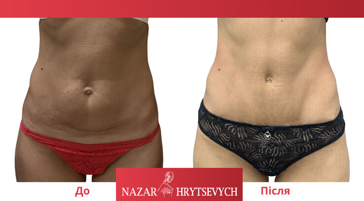 Фото пластики живота
