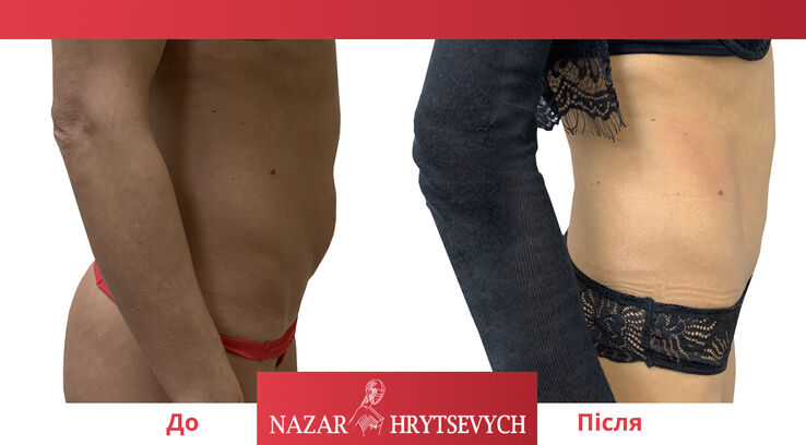 Коррекция живота абдоминопластика до и после