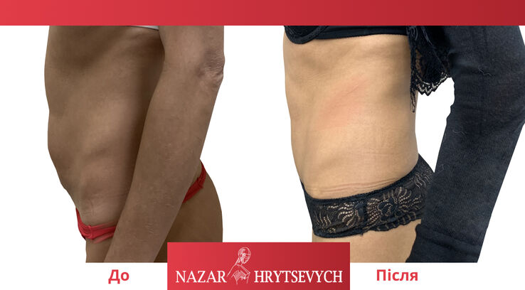 До и после коррекции живота абдоминопластика до и после