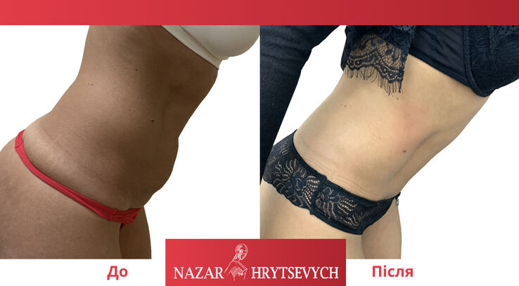 Коррекция живота до и после