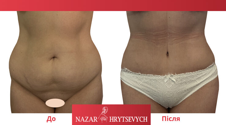 Пример коррекции живота