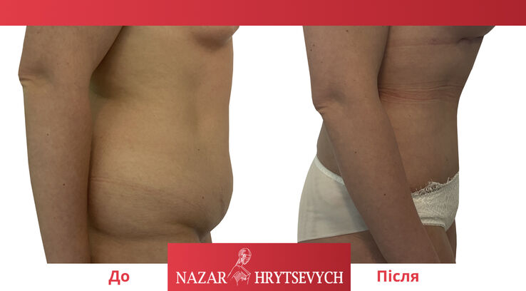 Пример абдоминопластики - коррекции живота
