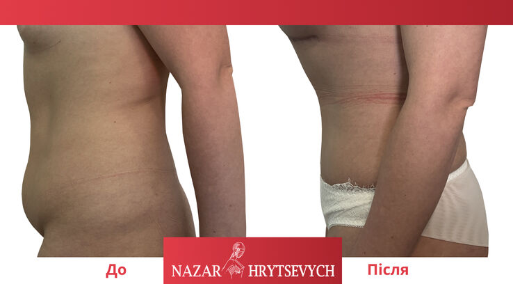 Фото до и после коррекции живота