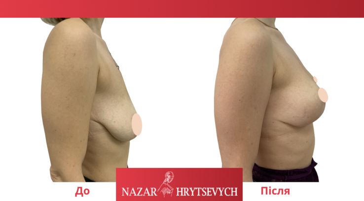 До и после подтяжки груди до и после