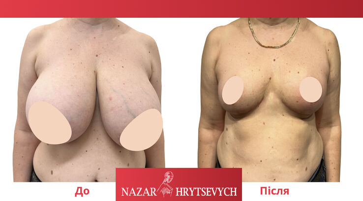 Операция по уменьшению груди до и после