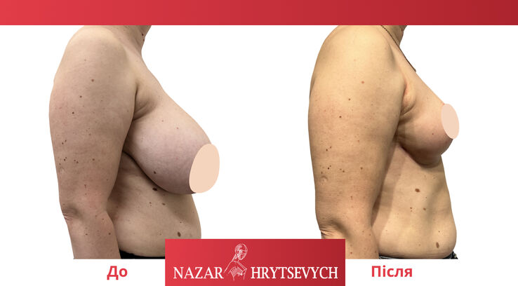 Уменьшение груди до и после