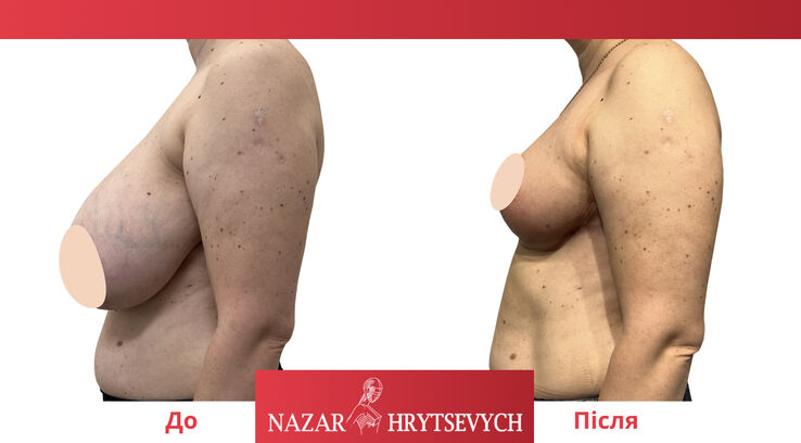 До и после уменьшения груди до и после