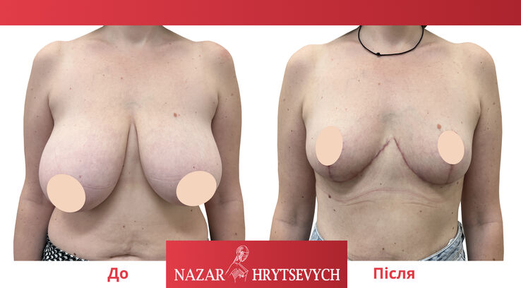 Пример операции по уменьшению груди