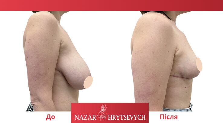 До и после операции по уменьшению груди