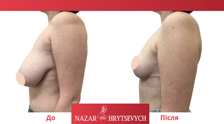 Пример уменьшения груди