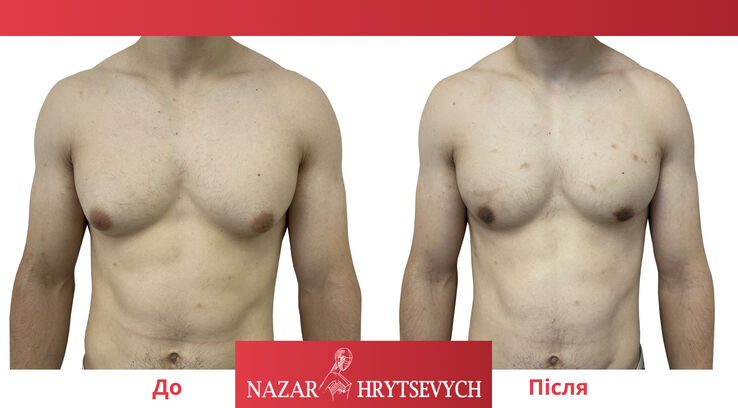 Гінекомастія до і після