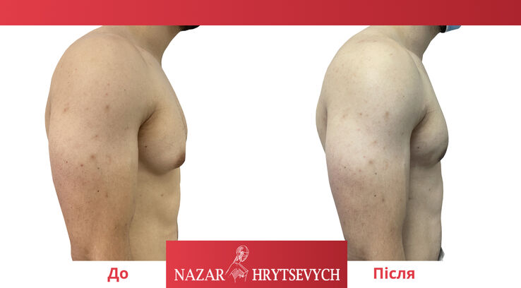 Гінекомастія у чоловіків до і після