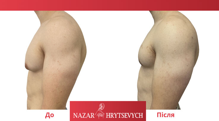 Лікування гінекомастії до і після