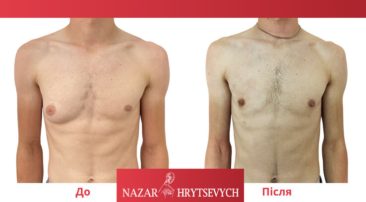 Гінекомастія у чоловіків операція до і після