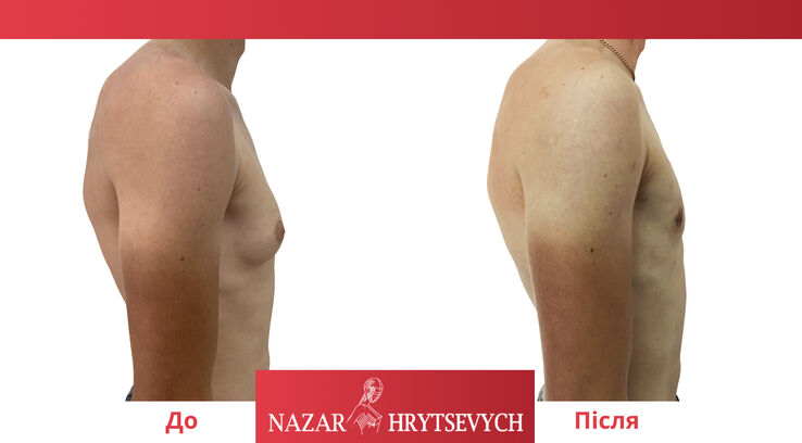 Приклад операції по гінекомастії