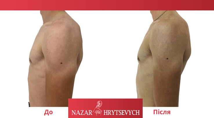 Приклад операції по гінекомастії у чоловіків до і після