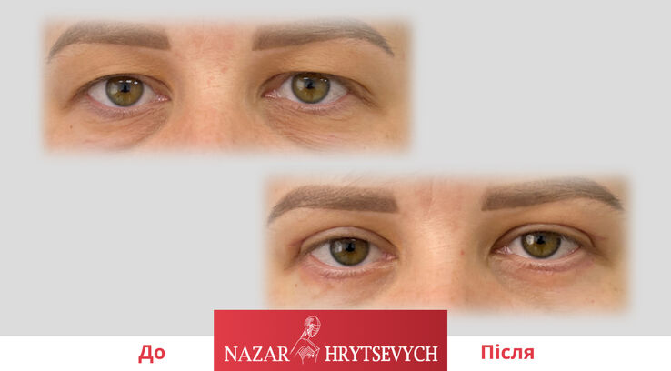 До і після блефаропластики
