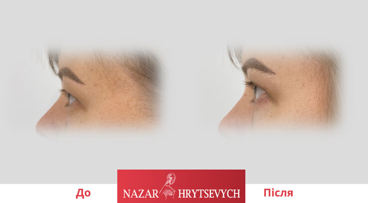 Приклад блефаропластики